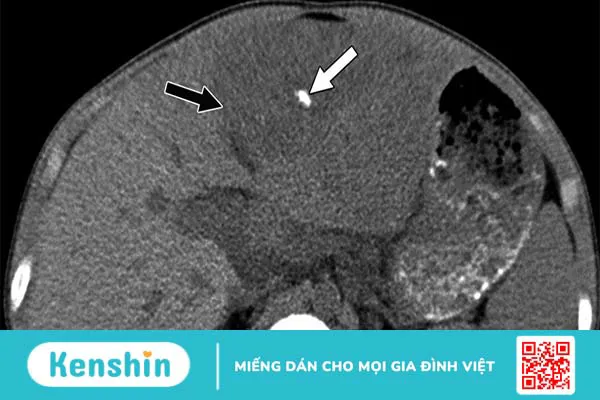 Vôi hóa gan là bệnh gì? Điều trị bệnh vôi hoá gan như thế nào?