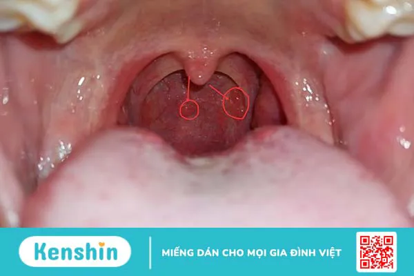 Vòm họng nổi hạt là biểu hiện của bệnh gì?