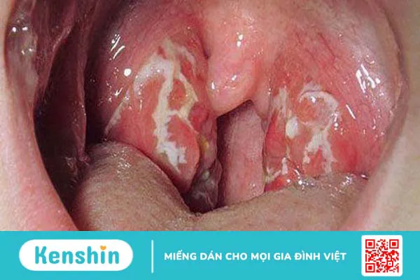 Vòm họng nổi hạt là biểu hiện của bệnh gì?