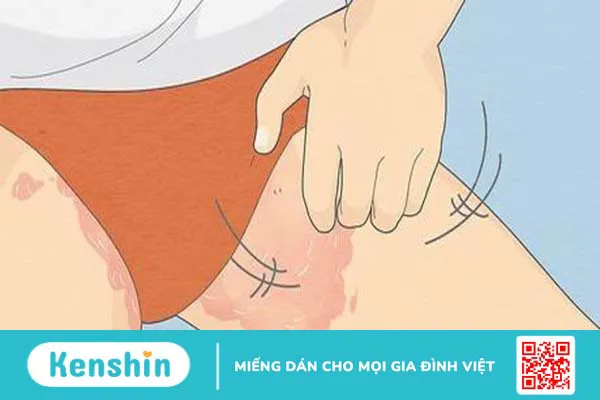 Vùng kín bị ngứa và nổi hạt: Nguyên nhân và cách điều trị