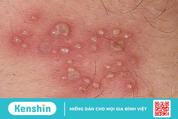 Vùng kín bị ngứa và nổi hạt: Nguyên nhân và cách điều trị