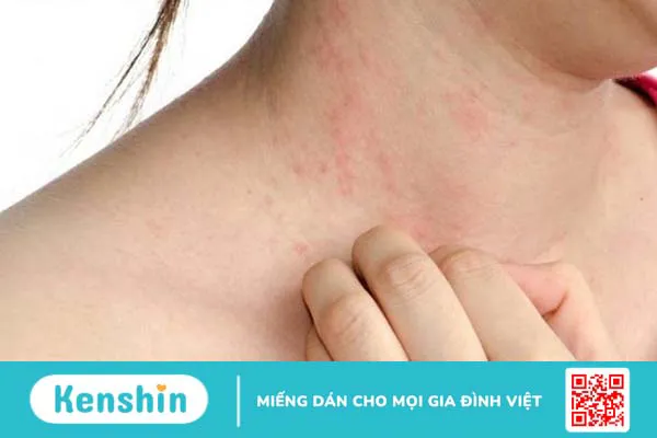 Xét nghiệm 60 dị nguyên là gì? Quy trình thực hiện như thế nào? 1