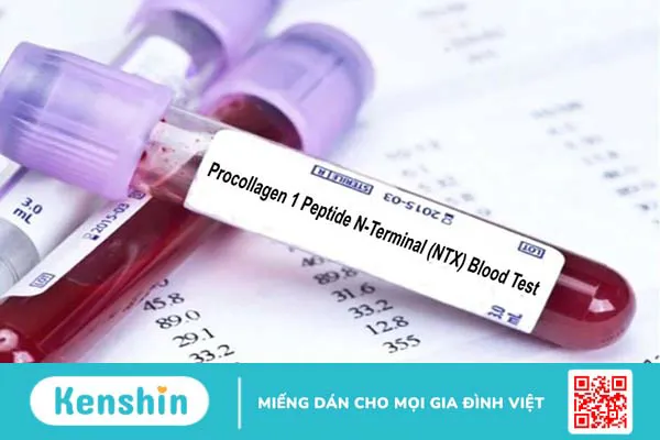 Xét nghiệm chất đánh dấu trong luân chuyển xương 2