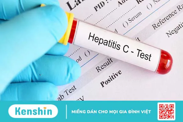 Xét nghiệm HCV Ab là gì? Vai trò của HCV Ab trong chẩn đoán bệnh viêm gan