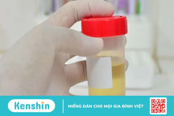 Xét nghiệm Microalbumin niệu phát hiện được những bệnh gì?