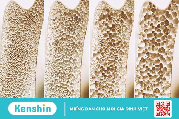 Xét nghiệm osteocalcin và bệnh loãng xương 1