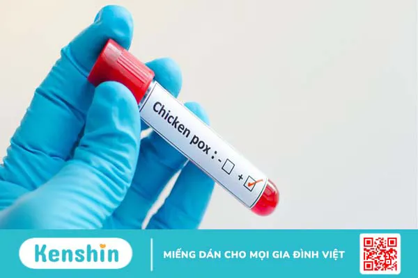 Xét nghiệm thủy đậu và những câu hỏi thường gặp