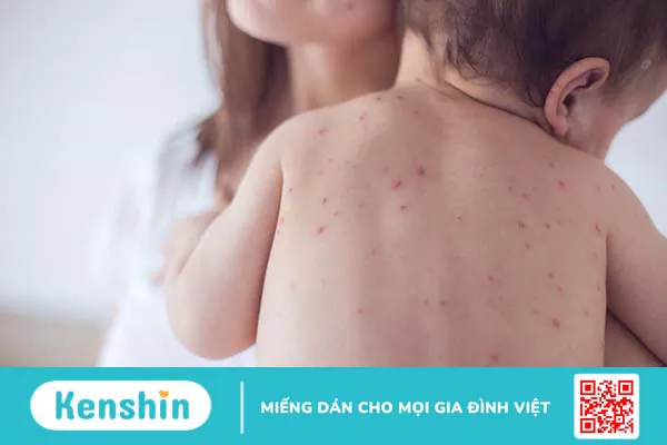 Xét nghiệm thủy đậu và những câu hỏi thường gặp