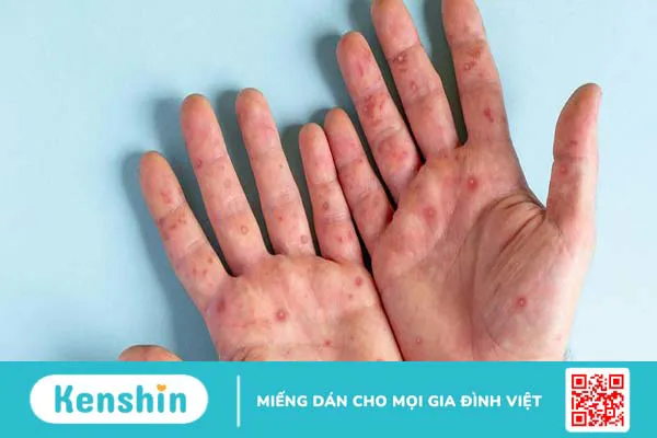 Xét nghiệm thủy đậu và những câu hỏi thường gặp