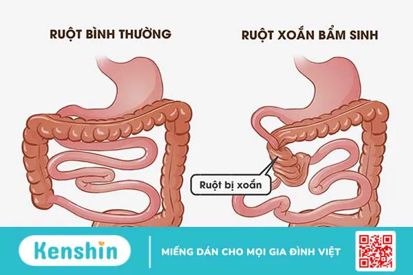 Xoắn ruột: Một tình trạng cấp cứu khẩn cấp