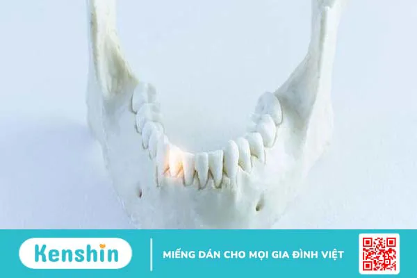 Xương hàm dưới: Giải phẫu, chức năng và một số bệnh liên quan