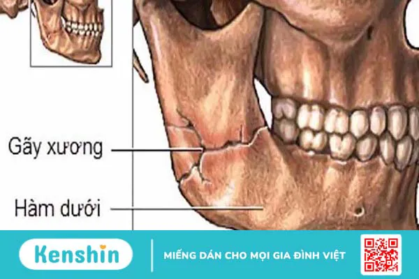 Xương hàm dưới: Giải phẫu, chức năng và một số bệnh liên quan