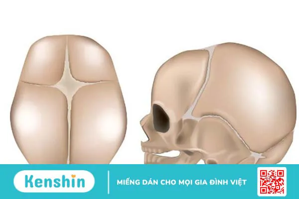 Xương lồi sau đầu ở trẻ sơ sinh có nguy hiểm không?