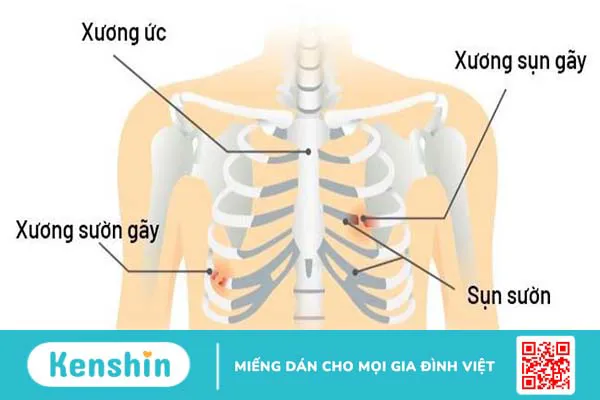 Xương sườn: Vị trí, cấu tạo, chức năng và một số bệnh lý thường gặp