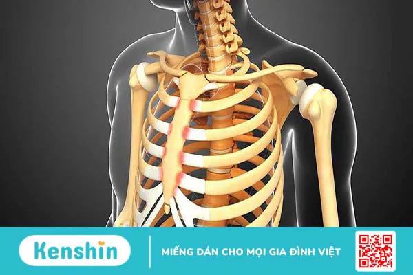 Xương sườn: Vị trí, cấu tạo, chức năng và một số bệnh lý thường gặp