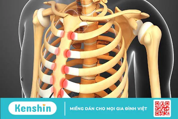 Xương ức là gì? Các bệnh lý liên quan đến xương ức