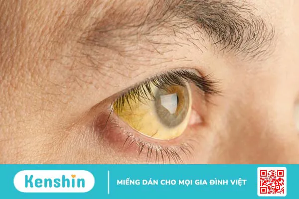 Yellow fever là gì? Triệu chứng và nguyên nhân gây bệnh