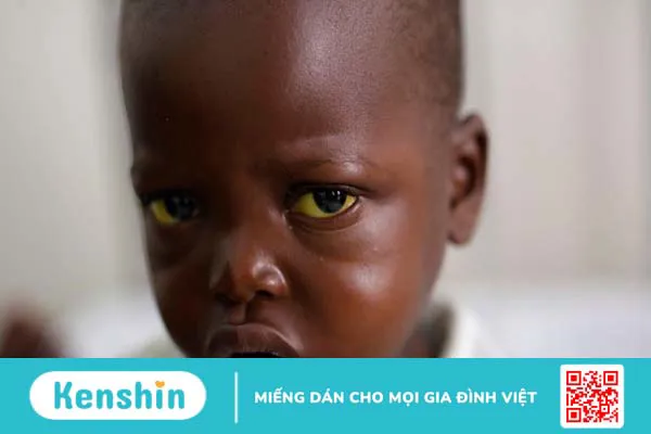 Yellow fever là gì? Triệu chứng và nguyên nhân gây bệnh