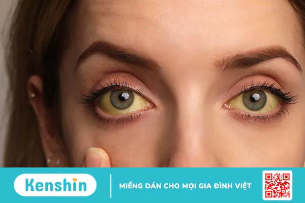 Yellow fever là gì? Triệu chứng và nguyên nhân gây bệnh